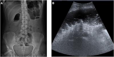 Stercoral Colitis in a Patient With Pediatric-Onset Systemic Lupus Erythematosus: Case Analysis and Review of the Literature